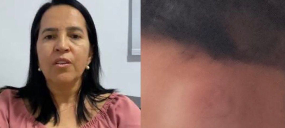 Criança de 7 anos sofre queda em escola de Bom Conselho; Secretária questiona versão da família.